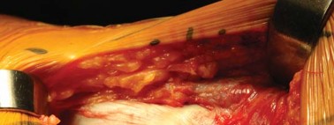 Illustration 57 for Successful Total Hip Replacement in Developmental Dysplasia