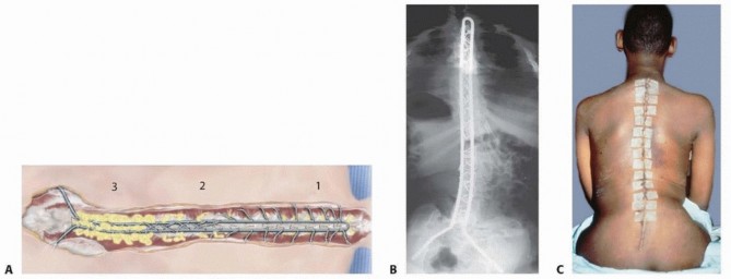 Illustration 35 for Duchenne Muscular Dystrophy: Is Spinal Fusion the Answer?