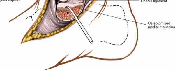 Illustration 10 for Step-by-Step Medial Side of the Ankle Approach Guide