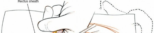 Illustration 15 for Expert Guide: Transperitoneal and Retroperitoneal Lumbar Access