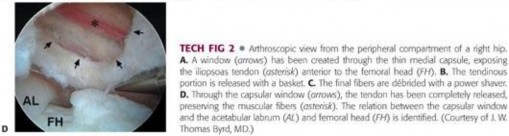 Illustration 114 for Stop the Snap: Hip Preservation for Snapping Iliopsoas Tendon