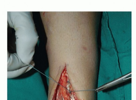 Illustration 55 for Foot Drop Surgery: How a Pin or Drill Elevates Tendon Transfer