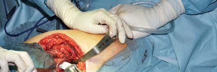 Illustration 65 for Collum Femoris Preserving: Achieve Better Primary Hip Outcomes