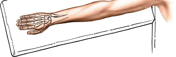 Illustration 2 for Dorsal Wrist Approach: Expert Access to the Column of the Distal Radius