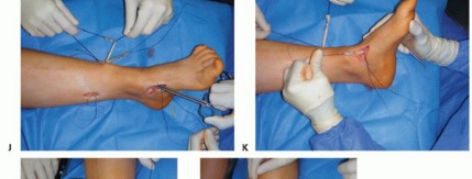 Illustration 22 for How Achilles Tendon Lengthening Fixes Equinocavovarus Foot