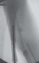 Illustration 10 for Solving Congenital Pseudarthrosis: Tibia with the Williams Rod
