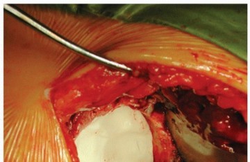 Illustration 20 for Cemented Acetabular Component: Achieving Optimal THA Stability