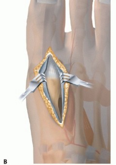 Illustration 15 for End Articular Cartilage Loss: Arthrosurface HemiCAP Resurfacing