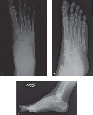 Illustration of radiograph of the foot - Dr. Mohammed Hutaif