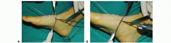 Illustration 17 for Mastering Midfoot Arthrodesis: Protect the Deep Neurovascular Bundle