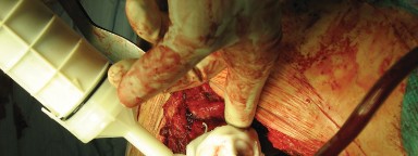 Illustration 61 for Figure Hip Resurfacing: Who Benefits and Who Should Avoid It?