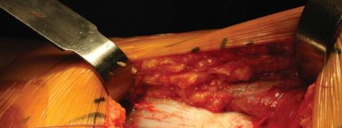 Illustration 59 for Successful Total Hip Replacement in Developmental Dysplasia