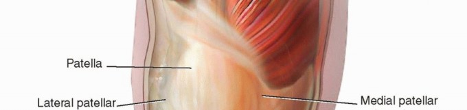 Illustration 2 for Correcting Stiffness in Revision TKA: Achieve Appropriate External Rotation