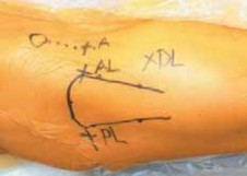 Illustration 9 for Resolving Femoral Head Neck Impingement: Arthroscopic FAI Solutions