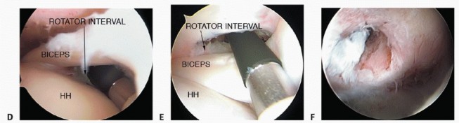 Illustration 12 for Stiff Shoulder? Discover Arthroscopic Capsular Release Solutions