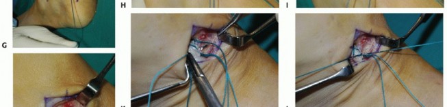 Illustration 20 for Restore Movement: Tendon Transfer for Common Peroneal Nerve Foot Drop