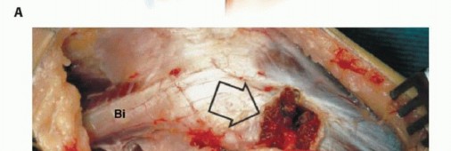 Illustration 2 for Beyond Amputation: The Type I Resection in Fibular Tumor Surgery