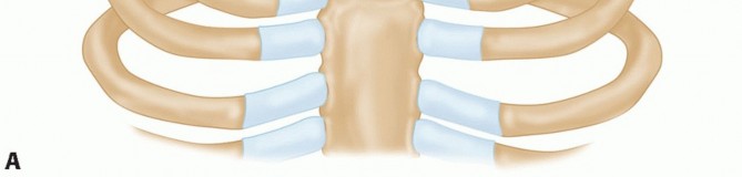 Illustration 9 for Optimizing SC Dislocation Repair After Medial Clavicle Resection