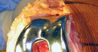 Illustration 15 for Monoblock Total Knee: When to Use & What to Avoid