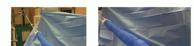 Relief & Stability: Treatment of Posterior Shoulder Instability