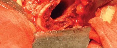 Illustration 23 for Approaches Posterolateral Surgical: A Guide to Enhanced Hip Surgery