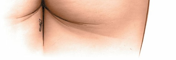 Illustration 36 for Pelvis & Acetabulum Approaches: Unlocking the Posterior Superior Iliac