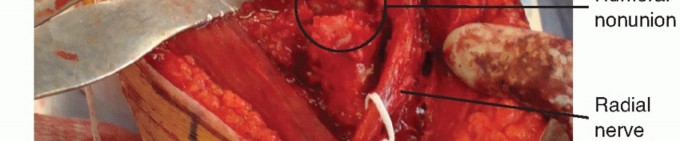 Illustration 18 for Surgical Approaches to Shoulder & Elbow: Pearls and Pitfalls