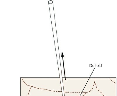 Illustration 3 for Step-by-Step Guide: Minimally Invasive Approach to the Proximal Humerus