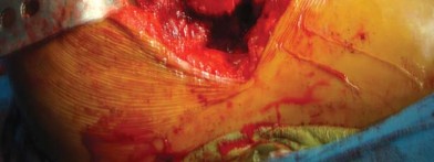 Illustration 57 for The Silent Hip: Achieving a Truly Silent, Pain-Free Joint