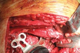 Illustration 24 for Optimizing Arthroplasty in Acute Fractures: Octopus System