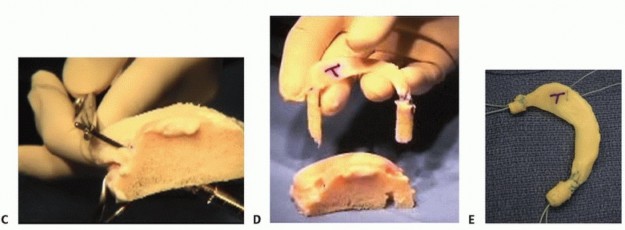 Illustration 22 for Symptomatic Knee? Meniscal Transplant for Anterior & Posterior Horns