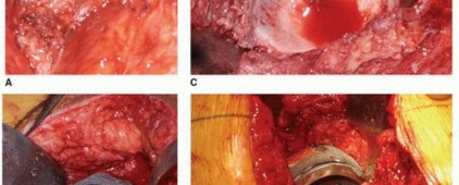 Illustration 2 for Uncemented Acetabular Component: Augments & Cup-Cages for Bone Loss