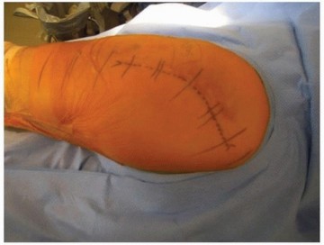 Illustration 7 for Extended Trochanteric Osteotomy: How et al Extended Revision THA Solutions