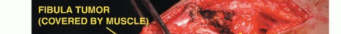 Illustration 35 for Beyond Amputation: The Type I Resection in Fibular Tumor Surgery