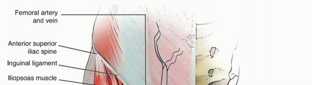 Illustration 5 for Total Hip Arthroplasty: Journey to Preventing Complications