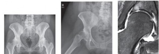 Illustration 76 for Understanding Hip Arthroscopy: The Basics Explained