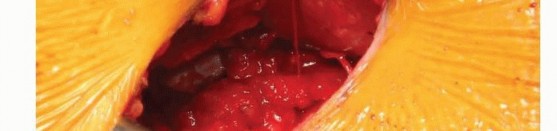 Illustration 40 for Anterior FAI Relief: Mini-Open Anterior Approach Explained
