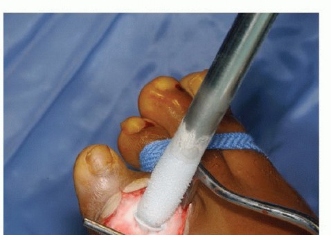 Illustration 20 for Avoid Major Surgery: Bone Tumor Treatment with Liquid Nitrogen Pour