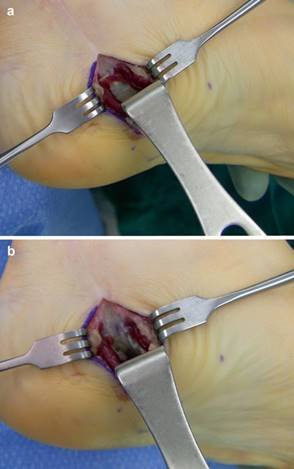 Illustration 38 for First Metatarsal Surgery: Expert Solutions for Foot & Ankle Pain