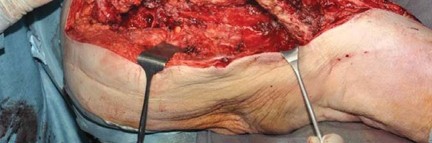 Illustration 74 for Optimizing Infected THA: The One Staged Approach Explained