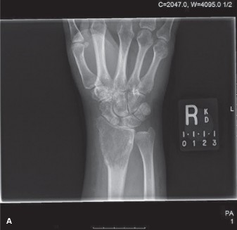 Giant Cell Tumor: Understanding Its Aggression Through a Case Study