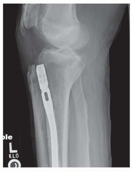 Illustration 27 for Advanced Nailing of the Mature Tibia: Overcoming Complexities
