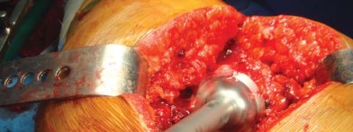 Illustration 54 for The Silent Hip: Achieving a Truly Silent, Pain-Free Joint