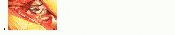 Illustration 20 for Revision Arthroplasty with Acetabular Bone Loss: The Antiprotrusio Cage