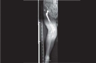 Illustration 68 for Optimizing Infected THA: The One Staged Approach Explained