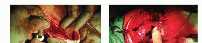 Illustration 15 for Exeter Hip Unit: Mastering Impaction Allografting for Femoral Bone Loss