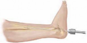 Illustration 15 for Solving Congenital Pseudarthrosis: Tibia with the Williams Rod