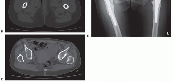 Illustration 6 for Special THA Techniques for Severe Deformities Around the Hip