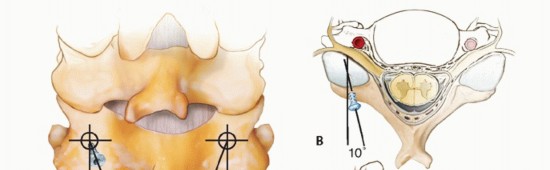 Illustration 19 for Achieve Stability: Posterior Cervical Lateral Mass Screw Fusion