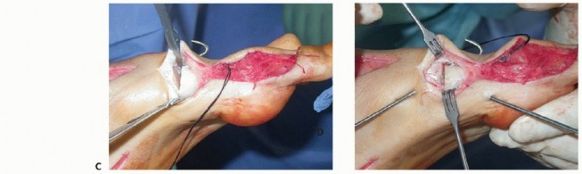 Illustration 44 for How Achilles Tendon Lengthening Fixes Equinocavovarus Foot